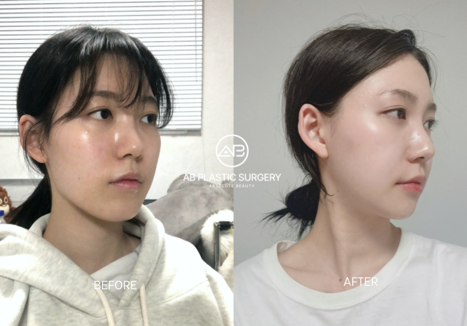 Wide-Face-Treatments-in-Korea