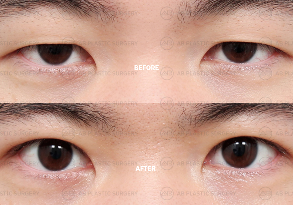 double-eyelid-surgery-korea-man