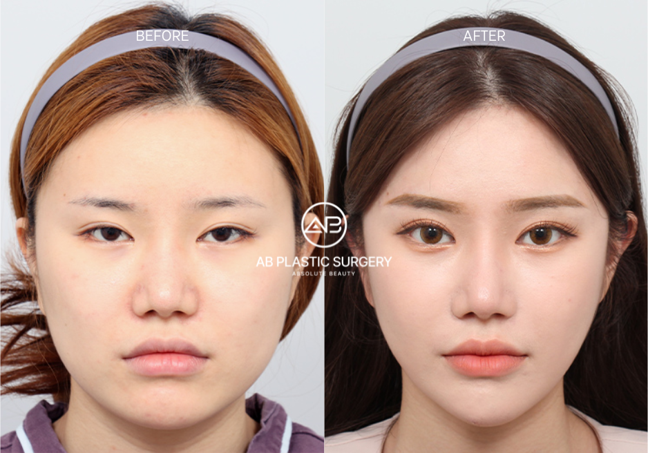 korean-beauty-standards-double-eyelids