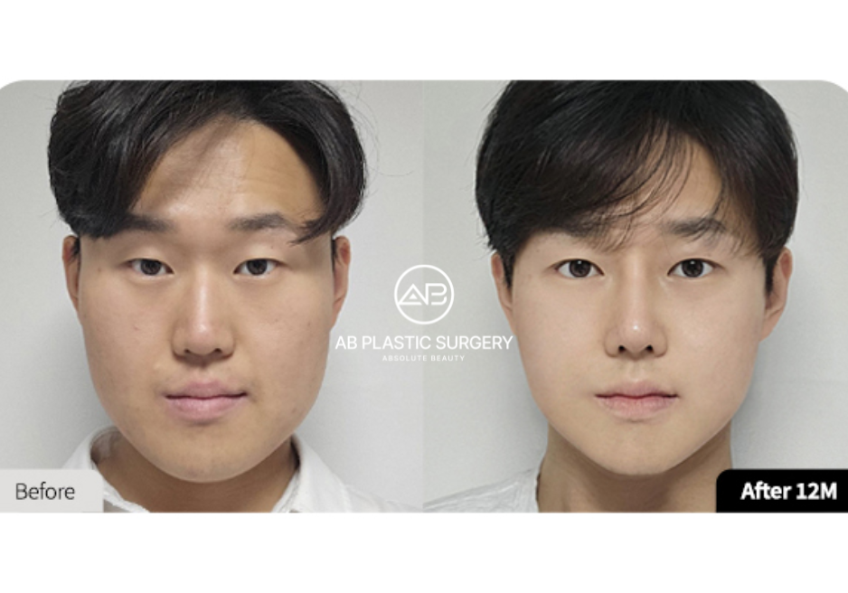 korean-beauty-standards-v-line-surgery