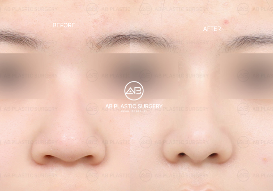 korean-nose-nostrills-reduction