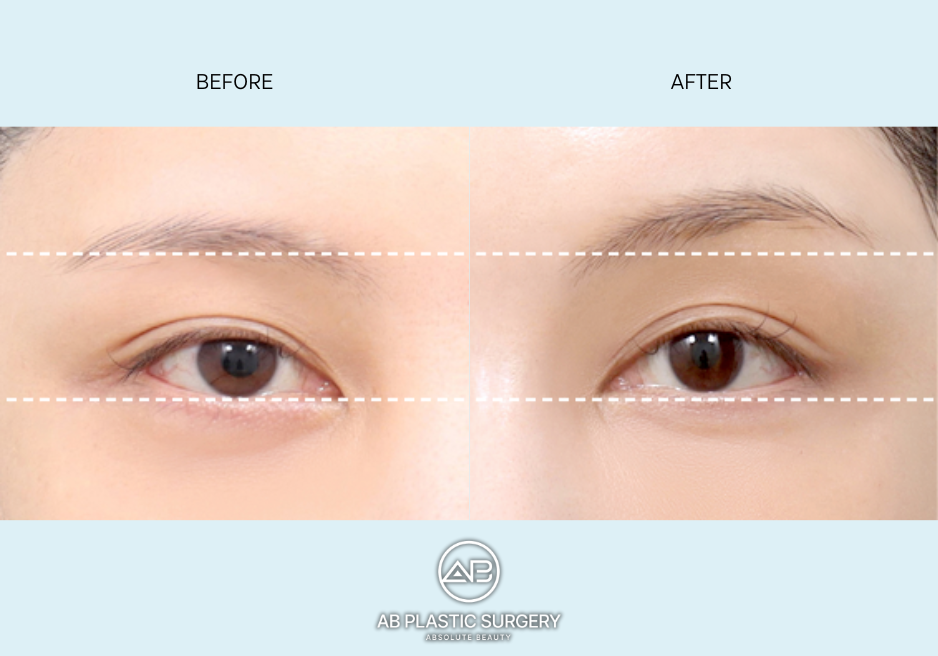 brow-lift-surgery-korea-before-after