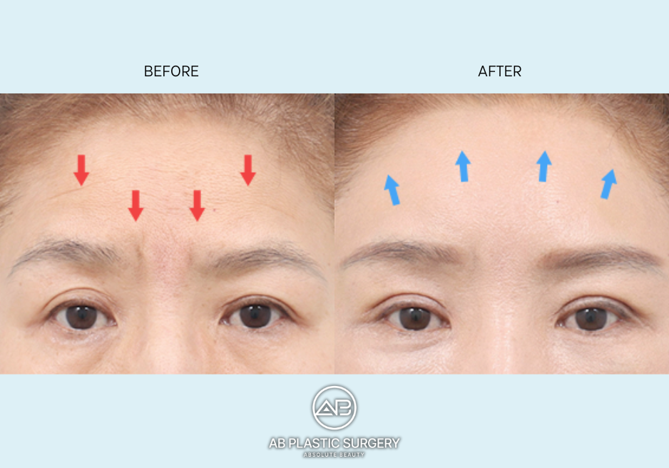 forehead-lift-surgery-before-after