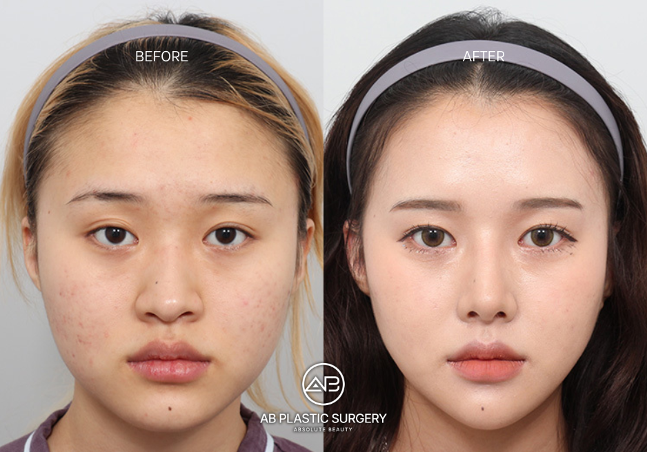 non-surgical-chin-augmentation-korea