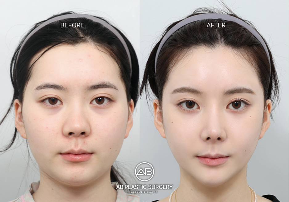 surgical-implant-chin-augmentation-korea