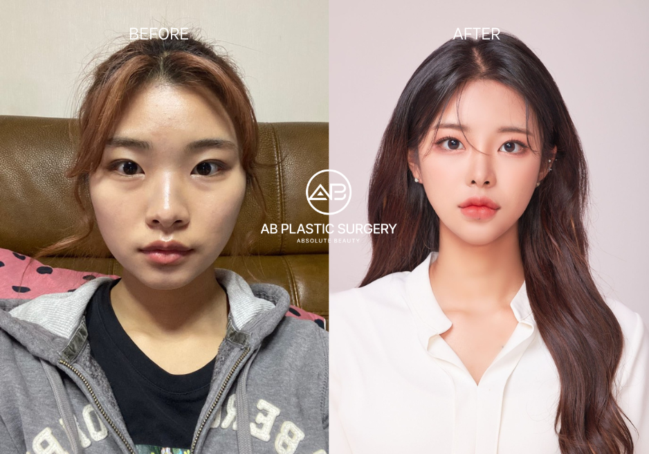 heart-shaped-face-surgery-korea-definition