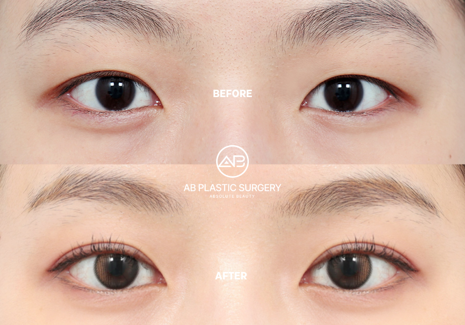 double-eyelid-surgery-aftercare-korea