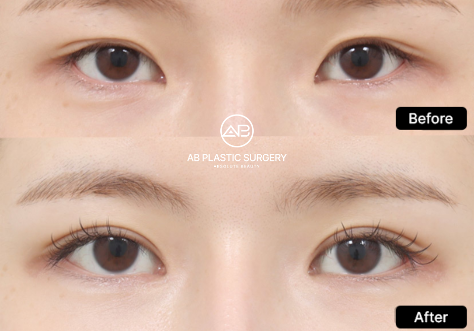 enhance-double-eyelid-surgery-results