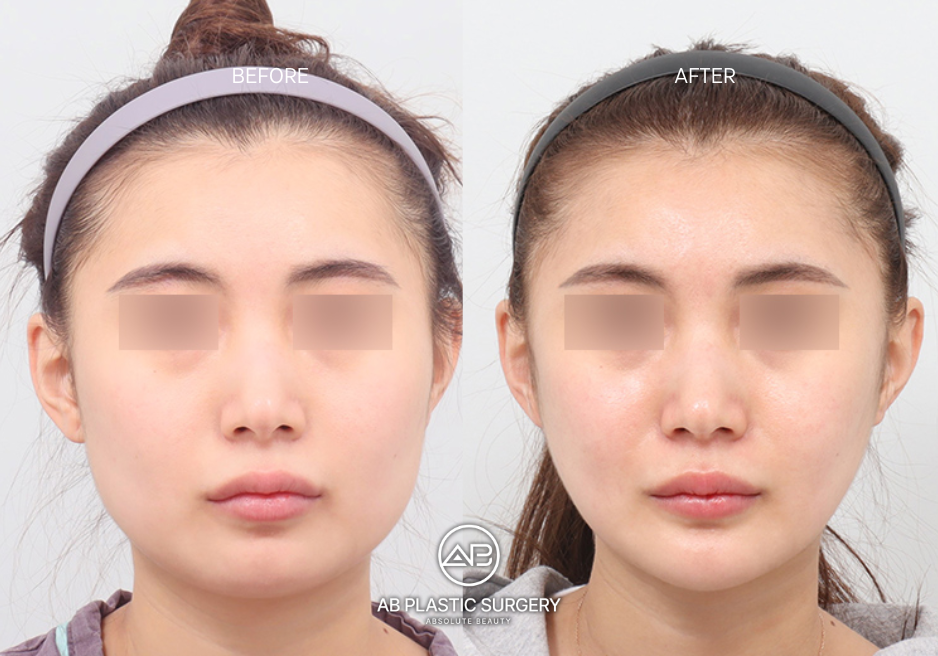 non-surgical-treatments-for-wide-face-in-korea-seoul