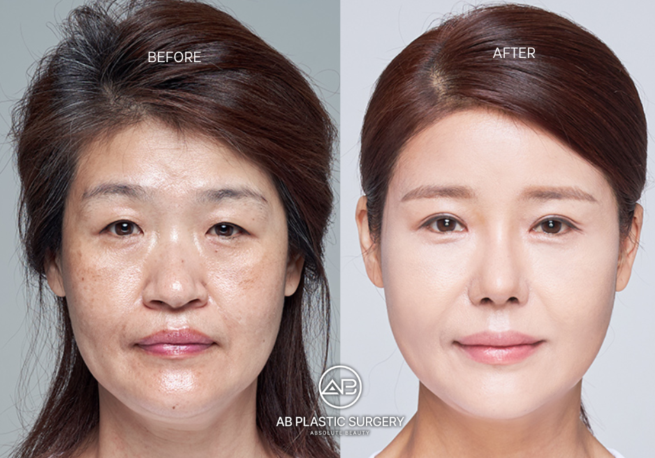 thermage-korea-for-skin-anti-aging