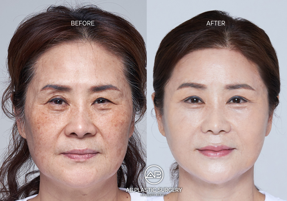 thermage-korea-for-skin-tightening