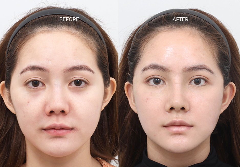 thermage-vs-other-skin-treatments-and-lasers-in-korea