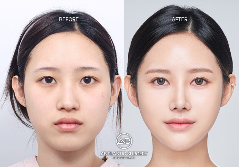 wide-face-plastic-surgery-south-korea