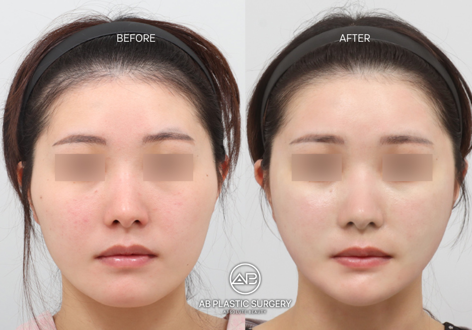 wide-face-surgery-korea-before-after