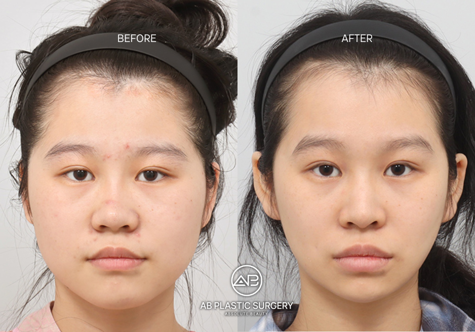 wide-face-surgery-korea-seoul