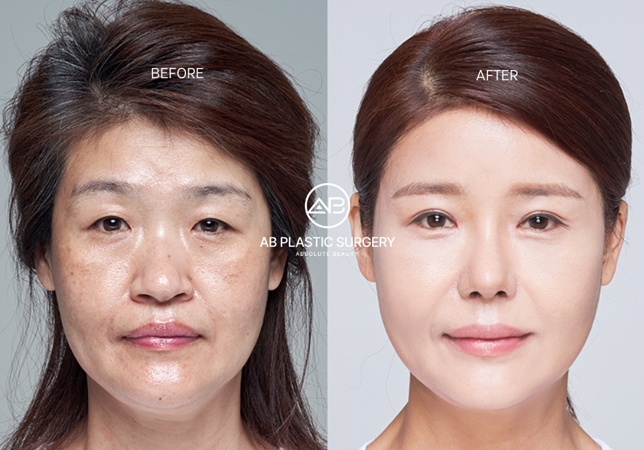 reason-to-choose-korea-for-plastic-surgery