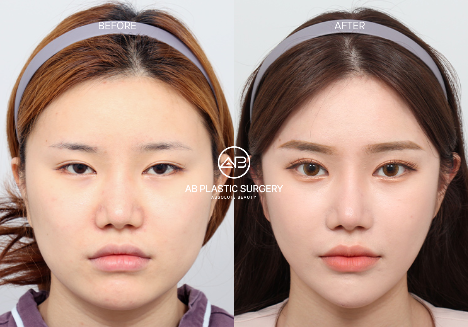 best-months-to-have-plastic-surgery-in-korea-seoul