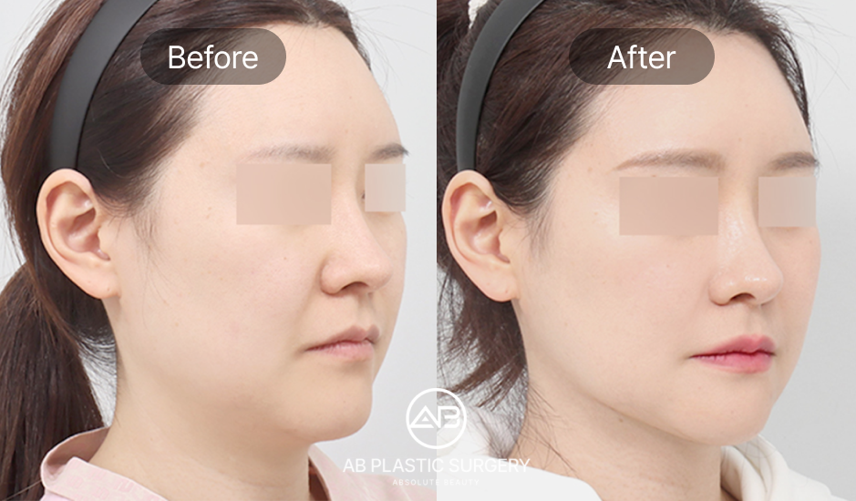 nasolabial-folds-facelift-in-south-korea-before-after