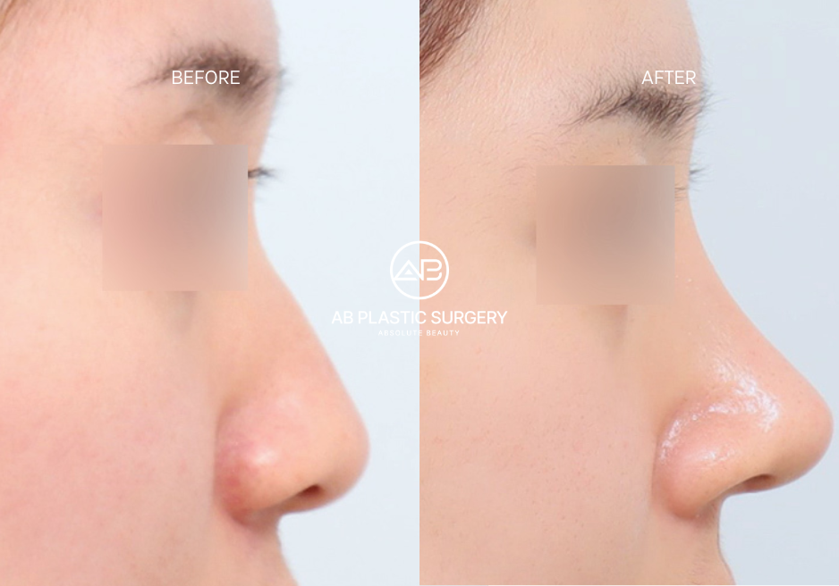 pre-sergery-preparation-by-season-korean-plastic-surgery-for-foreigners