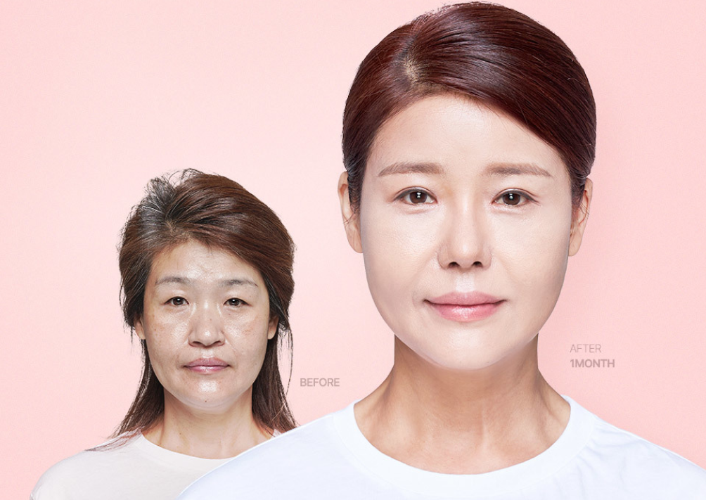 korean-facelift-smas-lifting-seoul