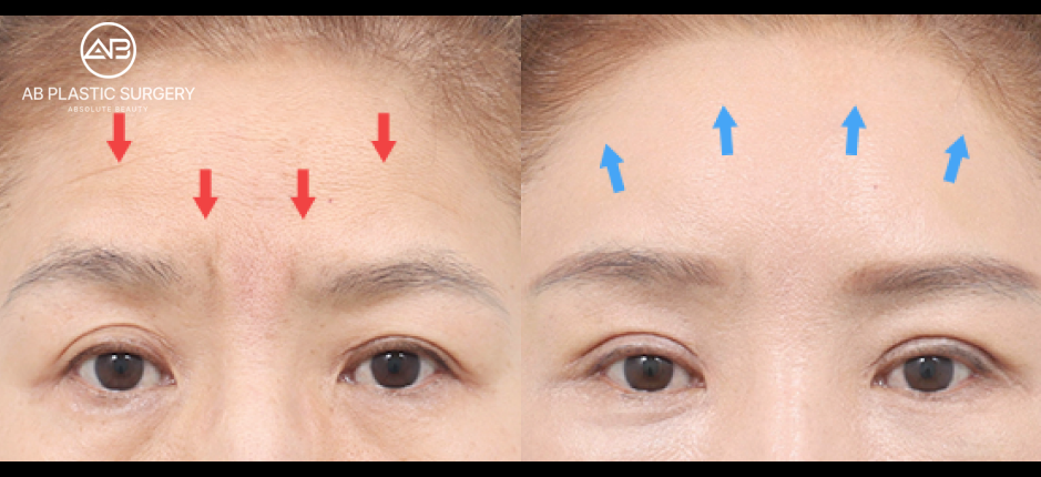 upper-blephatoplasty-for-anti-aging-korea-seoul-before-after