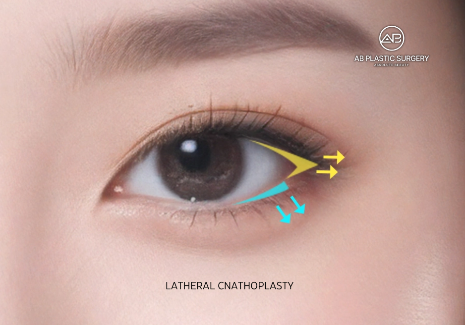 latheral-canthoplasty-for-makine-fox-eyeshape
