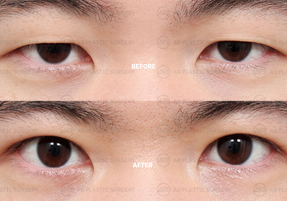 cause-of-the-uneven-eyes-and-how-to-improve-it-plastic-surgery-korea