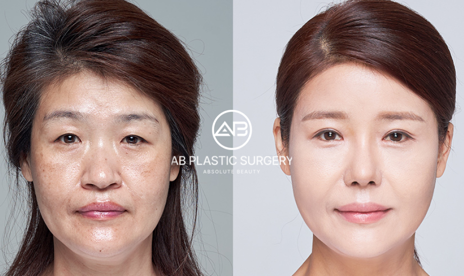 ponytail facelift for anti aging korea