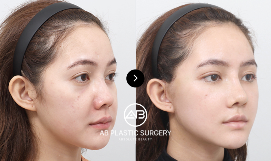 ponytail facelift vs other facelift techniques