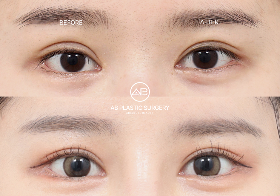 the-best-correction-method-for-uneven-eyes-assymetrical-eyes