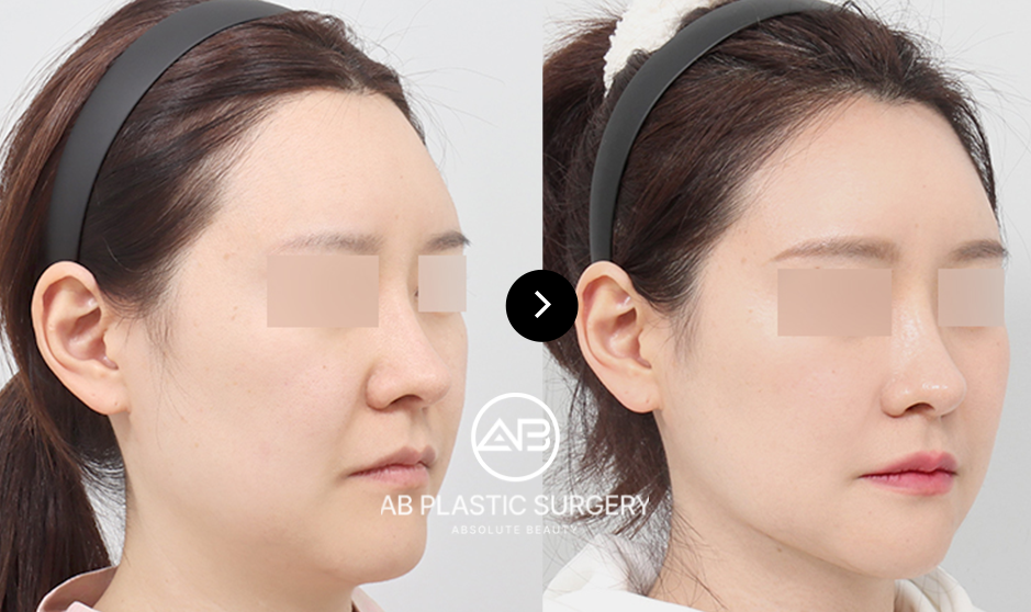 what are the potential risks of the ponytail facelift in korea seoul