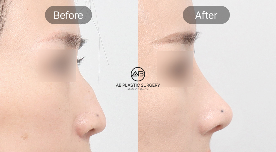 Before and After Results of Dorsal Hump Rhinoplasty at AB Plastic Surgery South Korea