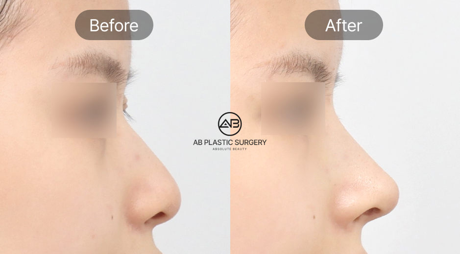 hawk nose correction results in South Korea