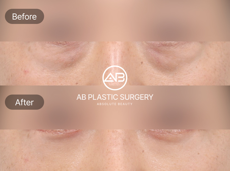 Before And After Results And Frequently Asked Questions About Lower Blepharoplasty