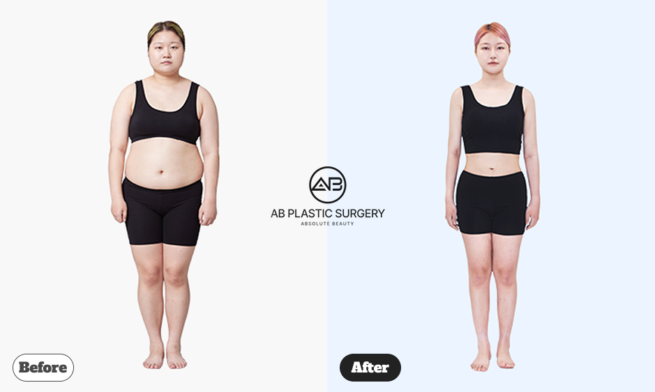 Before and after body contouring surgery cases at AB Plastic Surgery Korea expected to gain attention in 2026