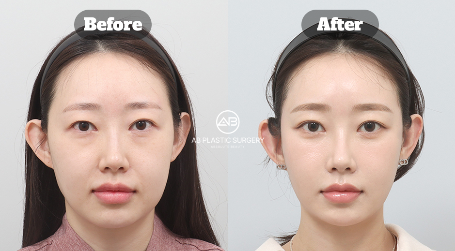 Before and After Facial Rejuvenation Showing Volume Restoration and Improved Facial Balance for Ozempic Face in South Korea
