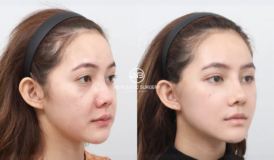 Korea mini facelift and face fat grafting before and after photo showing facial rejuvenation results