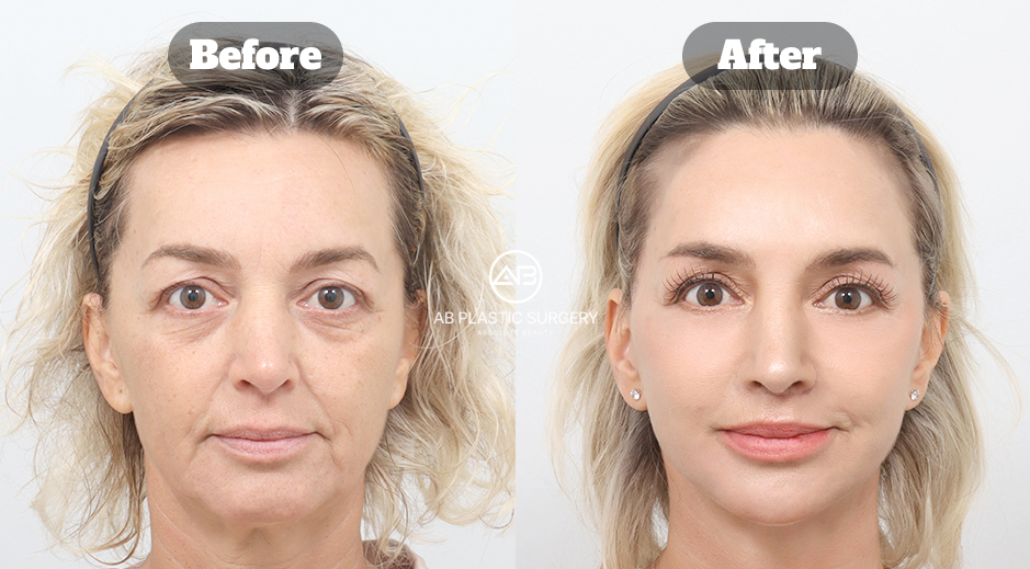 Before and after facelift surgery case at AB Plastic Surgery Korea