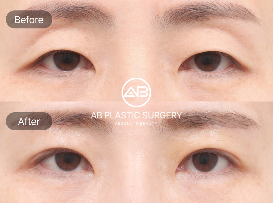 Before-and-After Photos of Upper Blepharoplasty, Epicanthoplasty, and Eyebrow Lift in South Korea