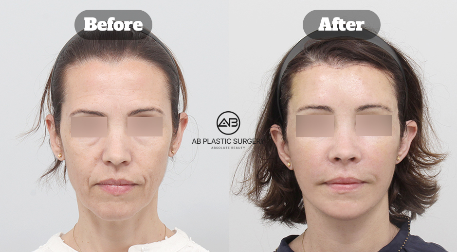 South Korea before and after photo of full SMAS facelift with endotine forehead lift, neck lift, double chin muscle tightening, forehead reduction surgery, and facial fat grafting