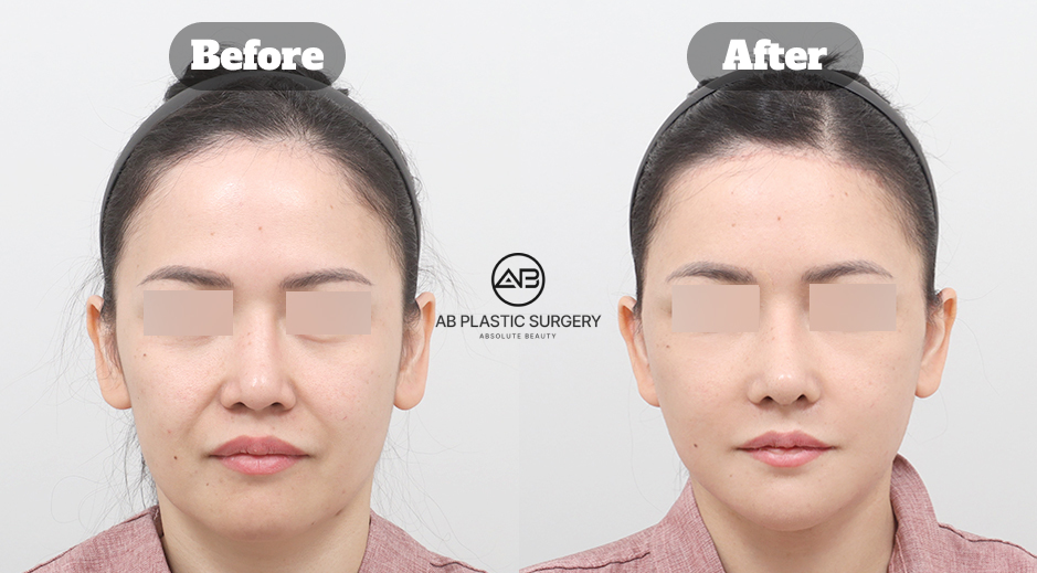 Korea before and after photo of full SMAS facelift with neck lift, forehead lift, forehead reduction, and facial fat grafting