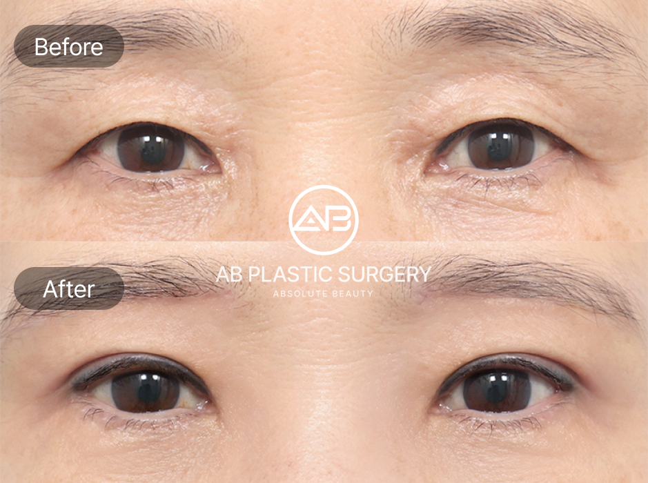 Before And After Results of Upper Blepharoplasty With Epicanthoplasty And Eyebrow Lift