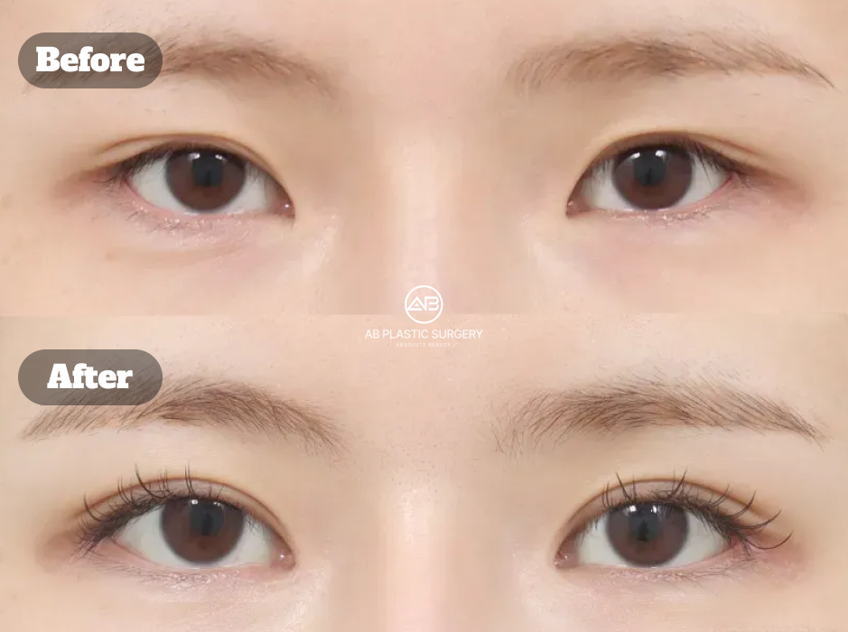 Before and after eye surgery case at AB Plastic Surgery Korea