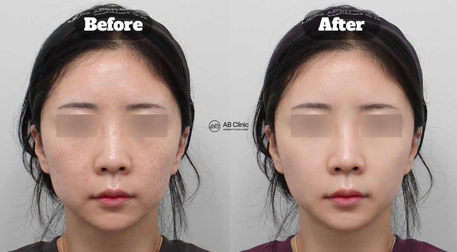 Korea before and after photo of Potenza RF microneedling treatment with Resnovex crystal skin booster and facial filler injections using hyaluronic acid (HA) fillers