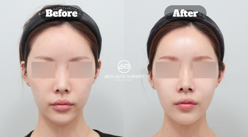 Before and after skin treatment care case at AB Clinic Korea