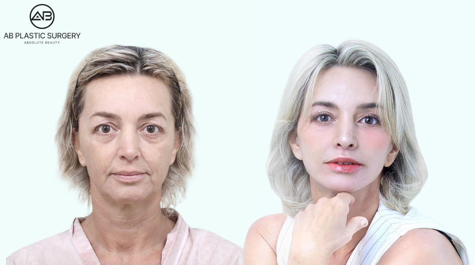 Korea before and after photo of full facelifting with neck lifting, upper and lower blepharoplasty, sub-brow lift, philtrum reduction, and facial fat grafting