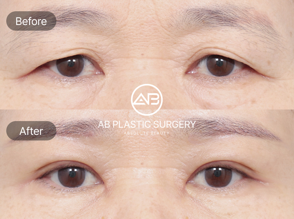 Before And After Results Showing Recovery Period of Upper Blepharoplasty, Epicanthoplasty, And Eyebrow Lift in South Korea