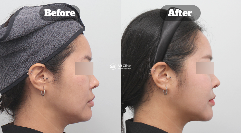 Korea before and after photo of Ultherapy (ultrasound skin lifting treatment) and Thermage (radiofrequency skin tightening treatment)