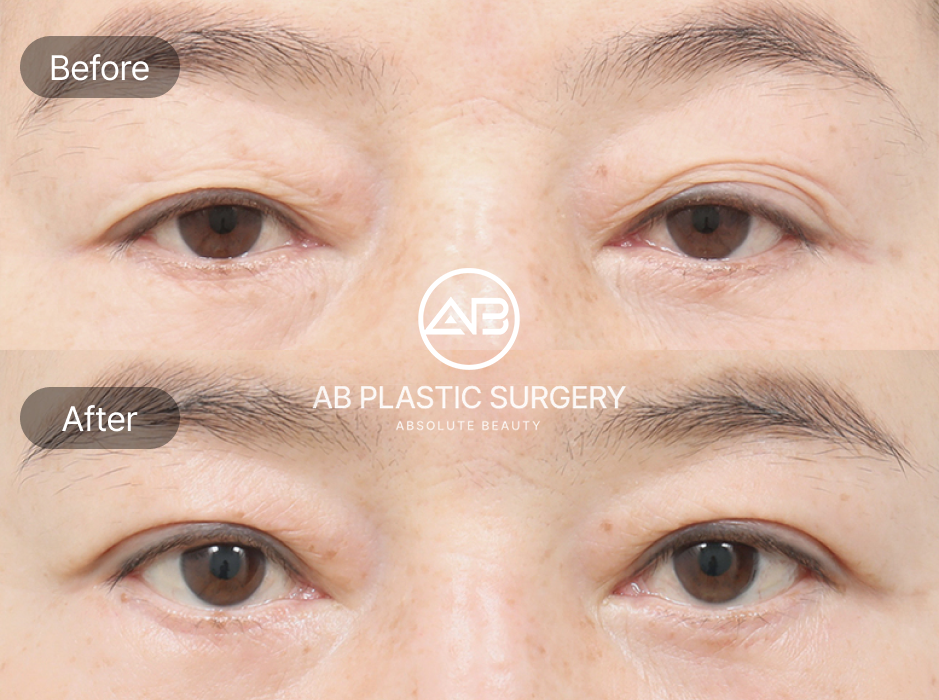 Before And After Results Demonstrating the Effects of Upper Blepharoplasty in South Korea