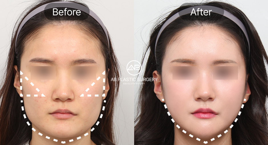 Korean Facial Contouring Surgery Before and After Photo – Cheekbone Reduction and Square Jaw Reduction